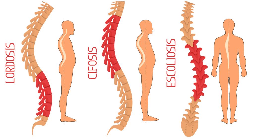 Prejuicios de lordosis, cifosis o escoliosis