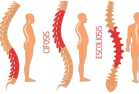 Prejuicios de lordosis, cifosis o escoliosis