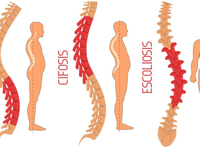 Prejuicios de lordosis, cifosis o escoliosis